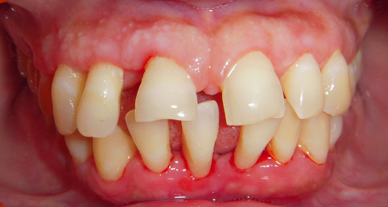 Treated Cases (Bridgs And Crowns)