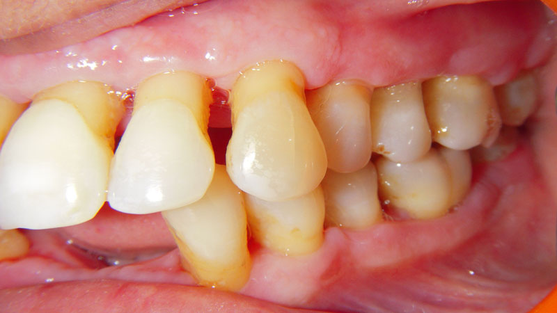 Treated Cases (Bridgs And Crowns)