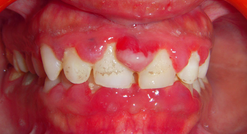 Treated Cases (Gingivectomy)