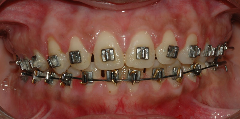 Treated Cases (Gingivectomy)