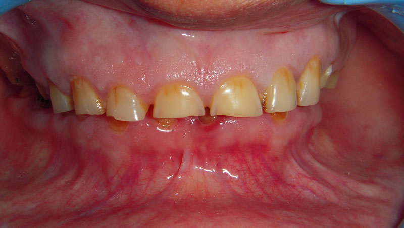 Treated Cases (Gum Lift Surgery Crown Lengthening)