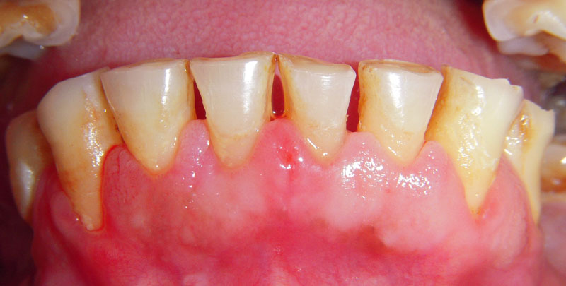 Treated Cases (Gum Lift Surgery Crown Lengthening)