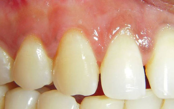 Treated Cases (Gum Regeneration)