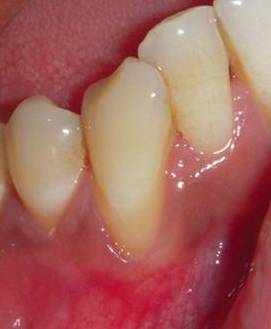 Treated Cases (Gum Regeneration)