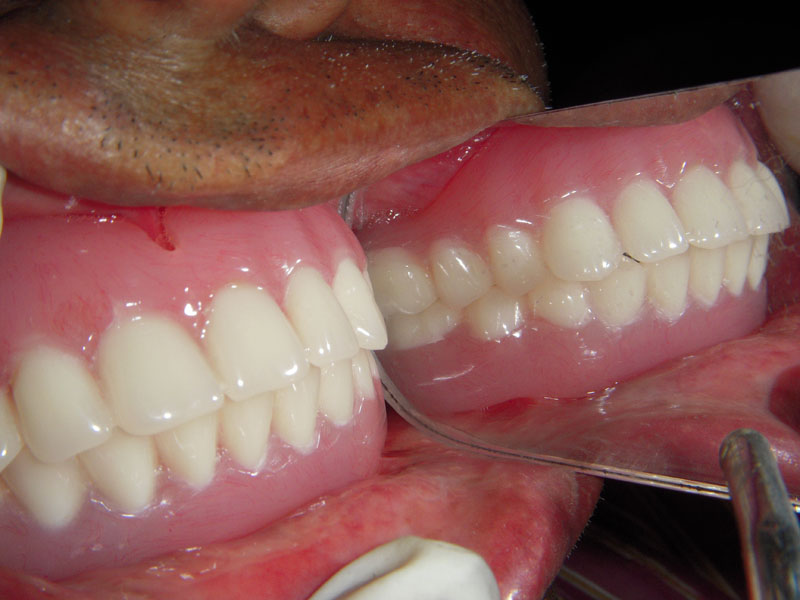 Treated Cases (Implant)