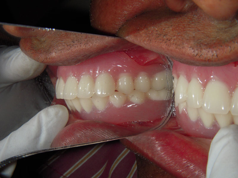 Treated Cases (Implant)