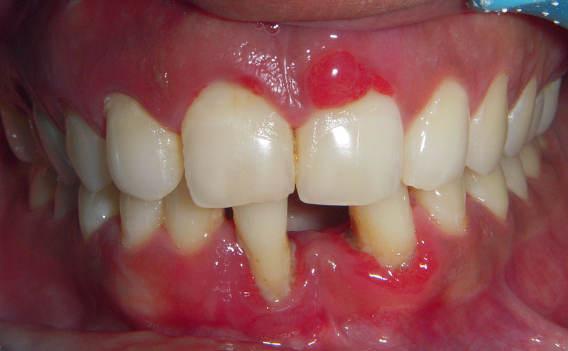 Treated Cases (Periodontal abscess)